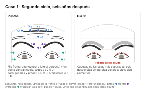 Bloqueo frontal y glabelar en mirada severa 