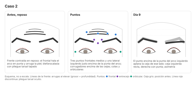 Caída de párpado acentuada con toxina botulínica