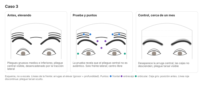 Bloqueo frontal y glabelar con toxina botulínica