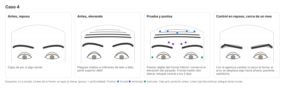 Bloqueo frontal en arrugas frontales