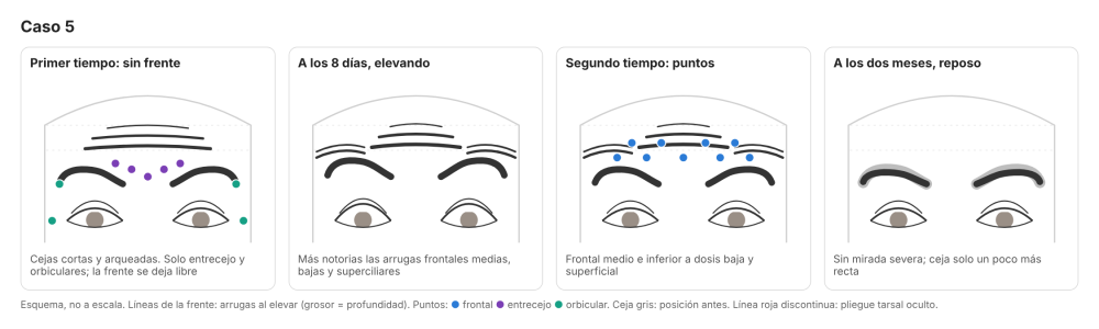 Bloqueo frontal en arrugas frontales