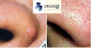Remoción pápula fibrosa del ala nasal