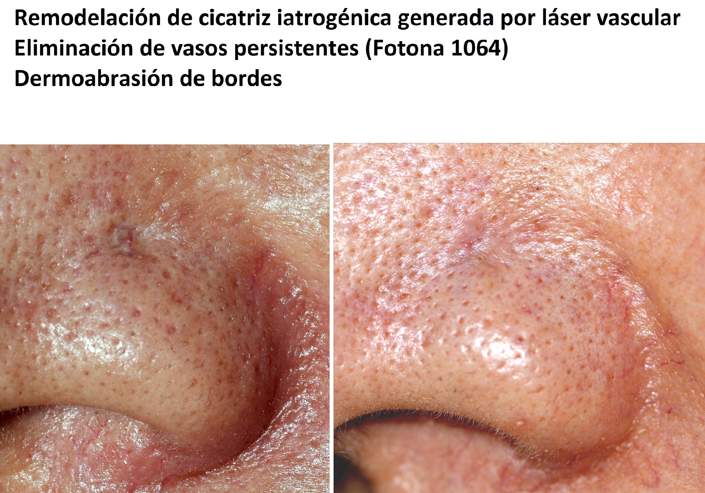 Corrección de cicatriz y vaso persistente en el ala nasal en tratamiento fallido con láser vascular