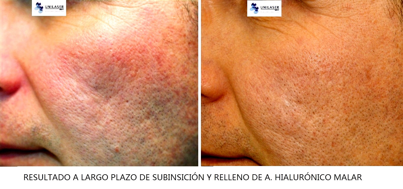 relleno acido hialurónico para cicatrices en valle