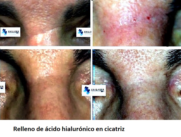 cicatriz tratada con relleno