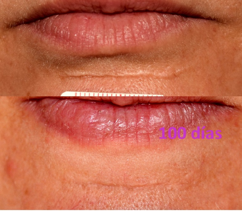 tratamiento cicatriz hipertrófica