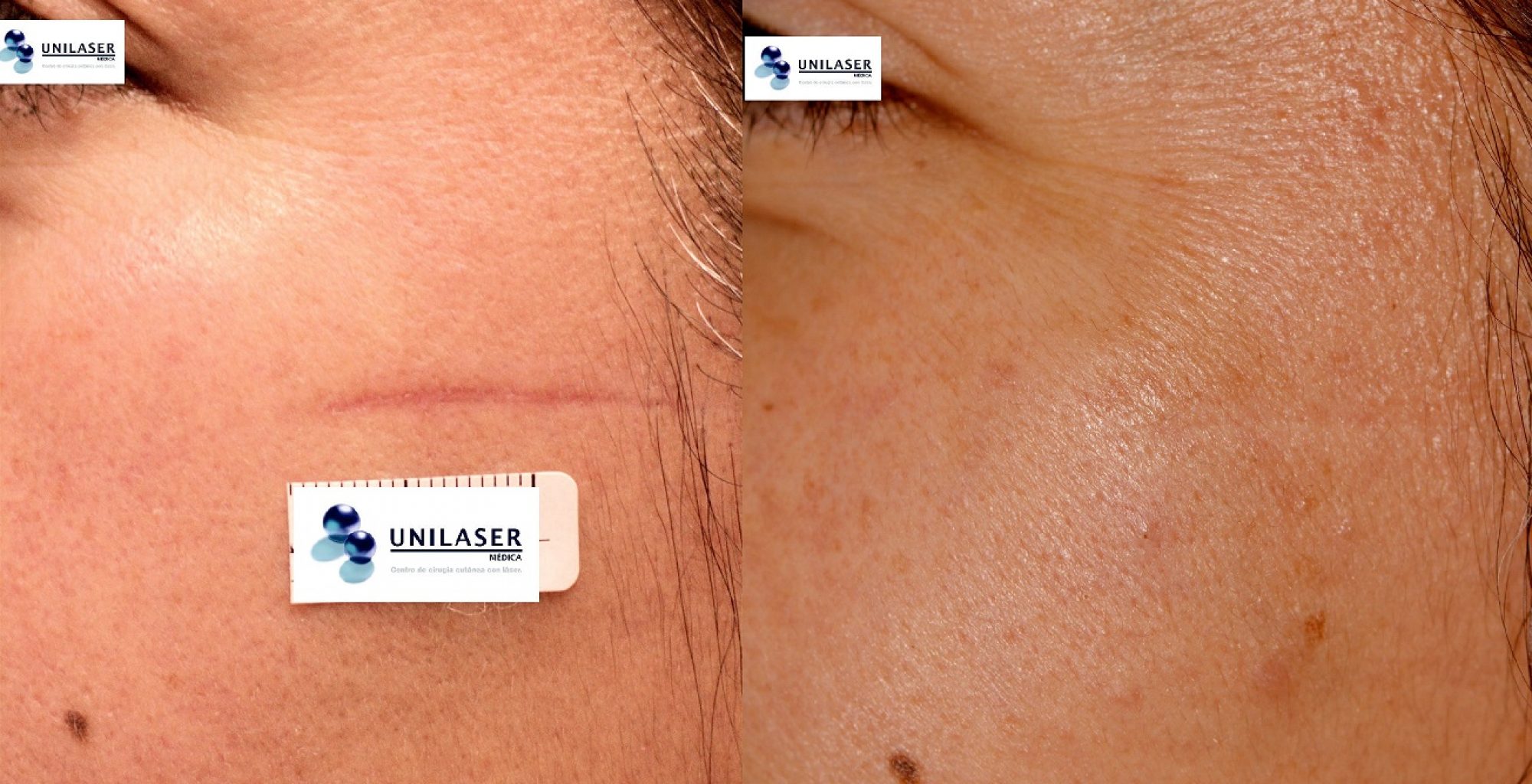 Cicatriz inmadura tratada con Fraxel