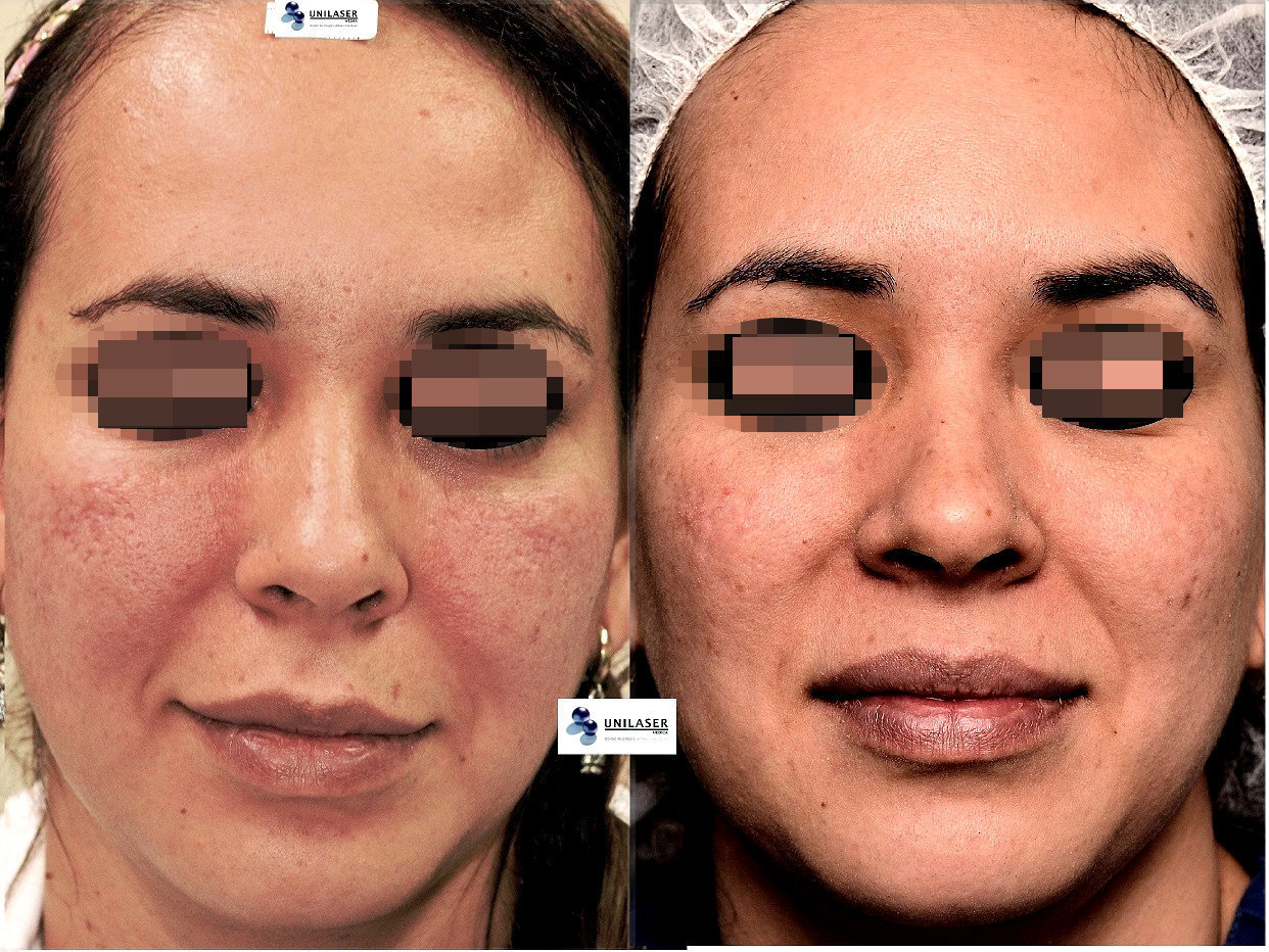 Der,oabrasiones por cicatrices del acné