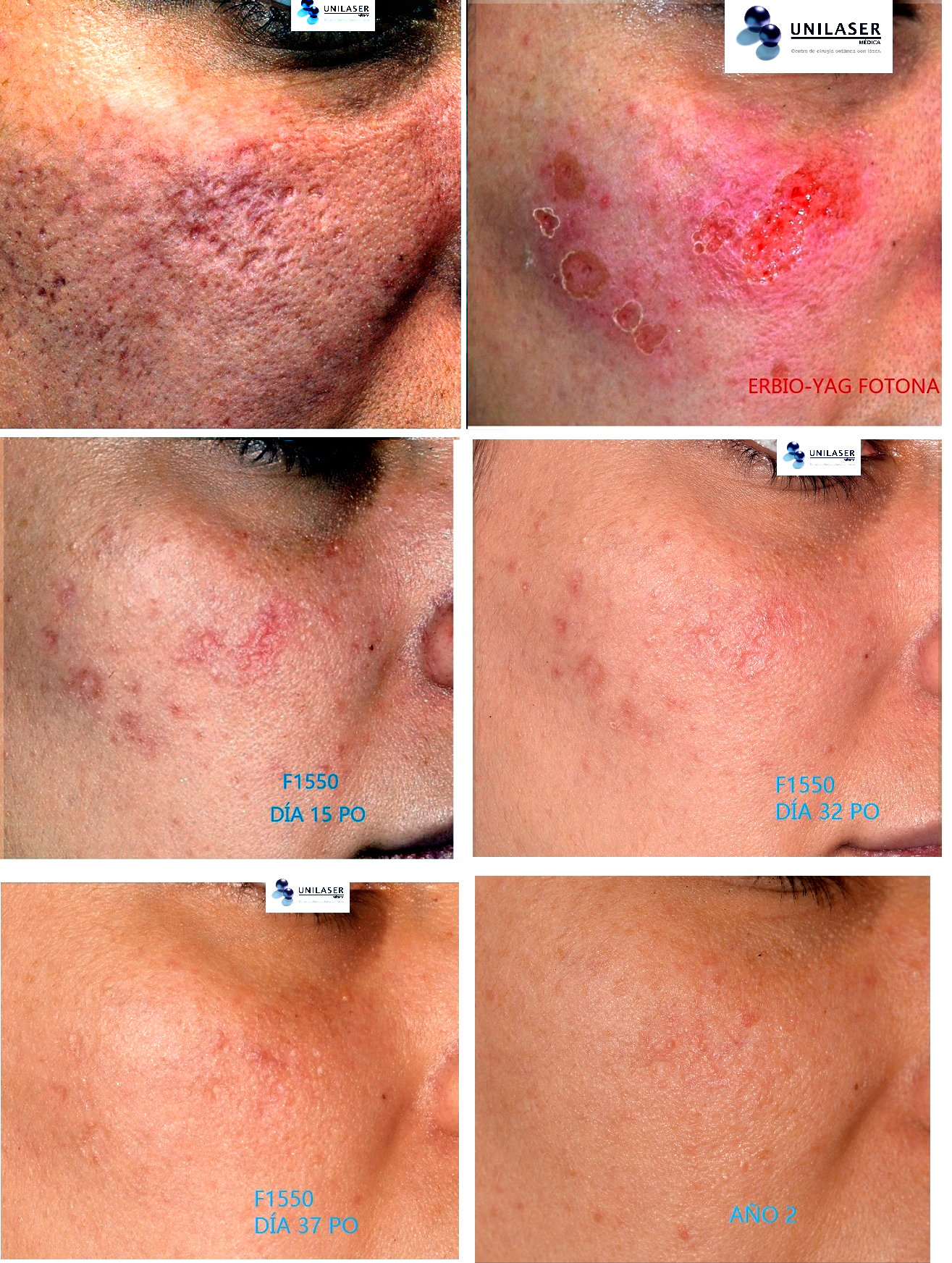 laser para cicatrices del acné