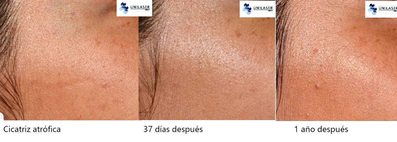 cicatriz atrófica tratada con Fraxel