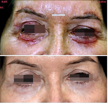 cicatriz posterior a blefaroplastia