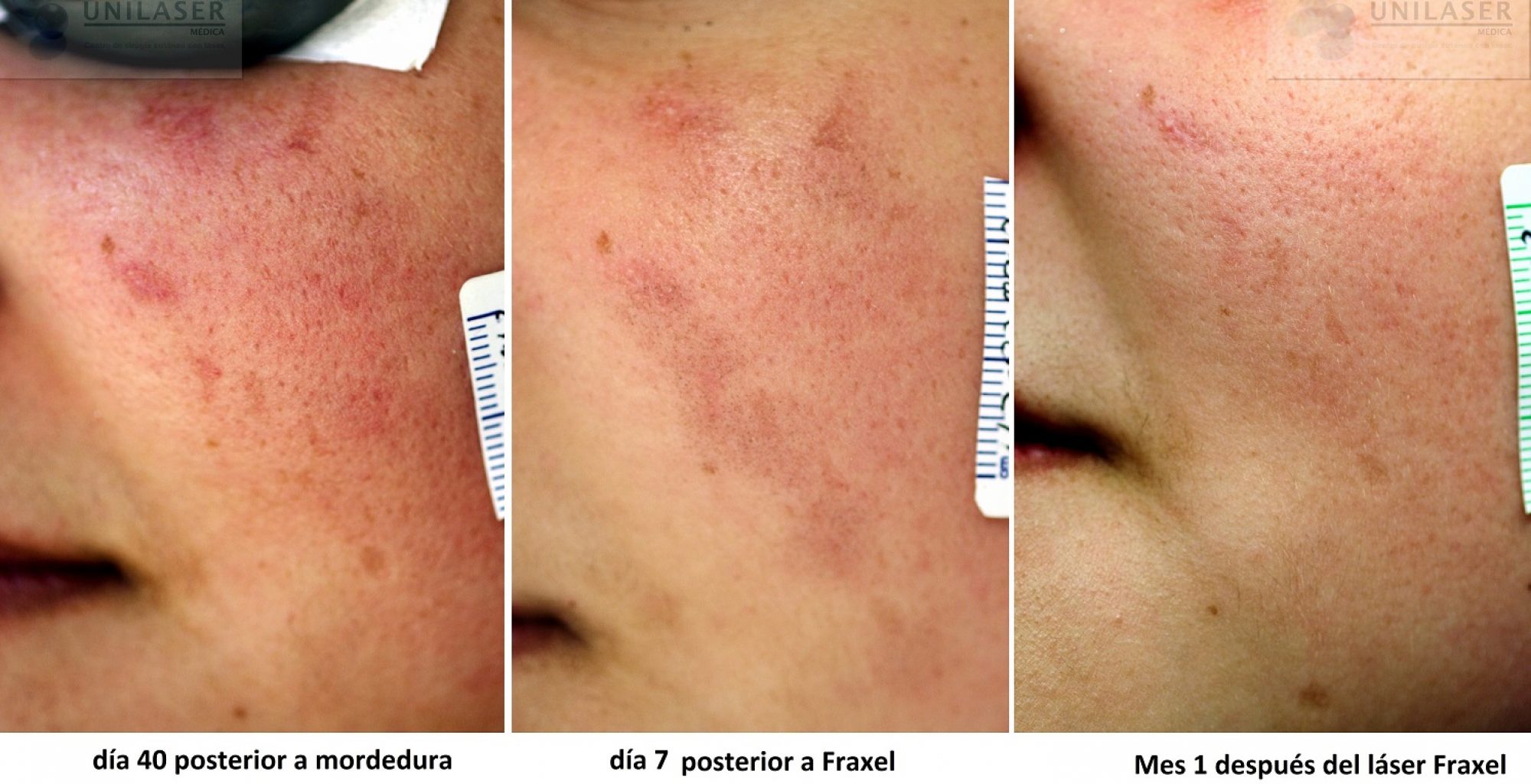 Tratamiento cicatrices láser Láser fraxel