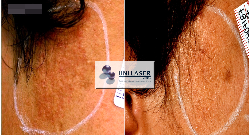 Fraxel en cicatrices atróficas