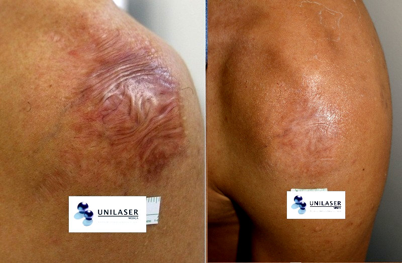 cicatriz posoperatoria tratada con Fraxel