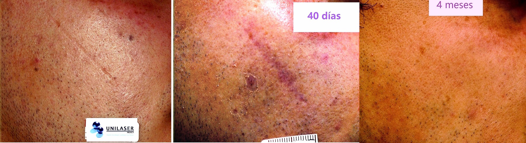 tratamiento cicatriz atrófica