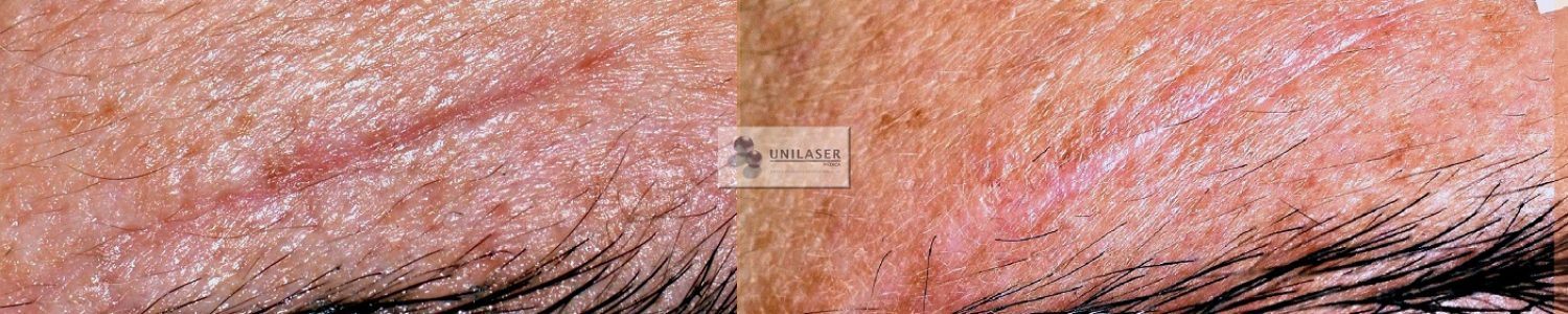 Cicatriz atrófica tratada con Fraxel