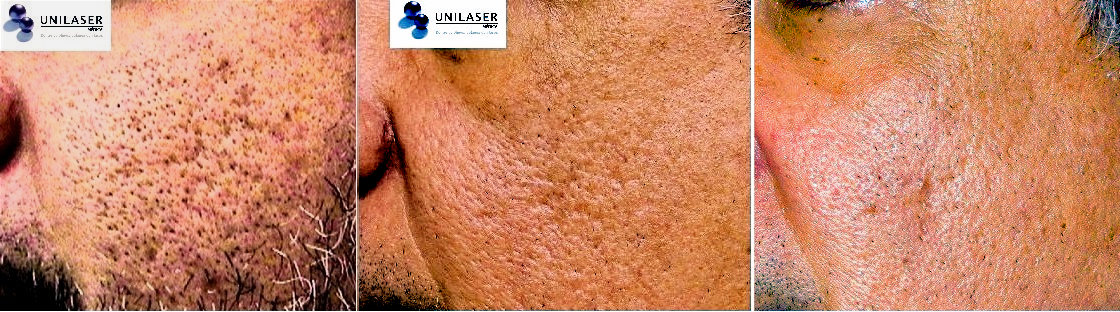 tratamiento láser cicatrices del acné