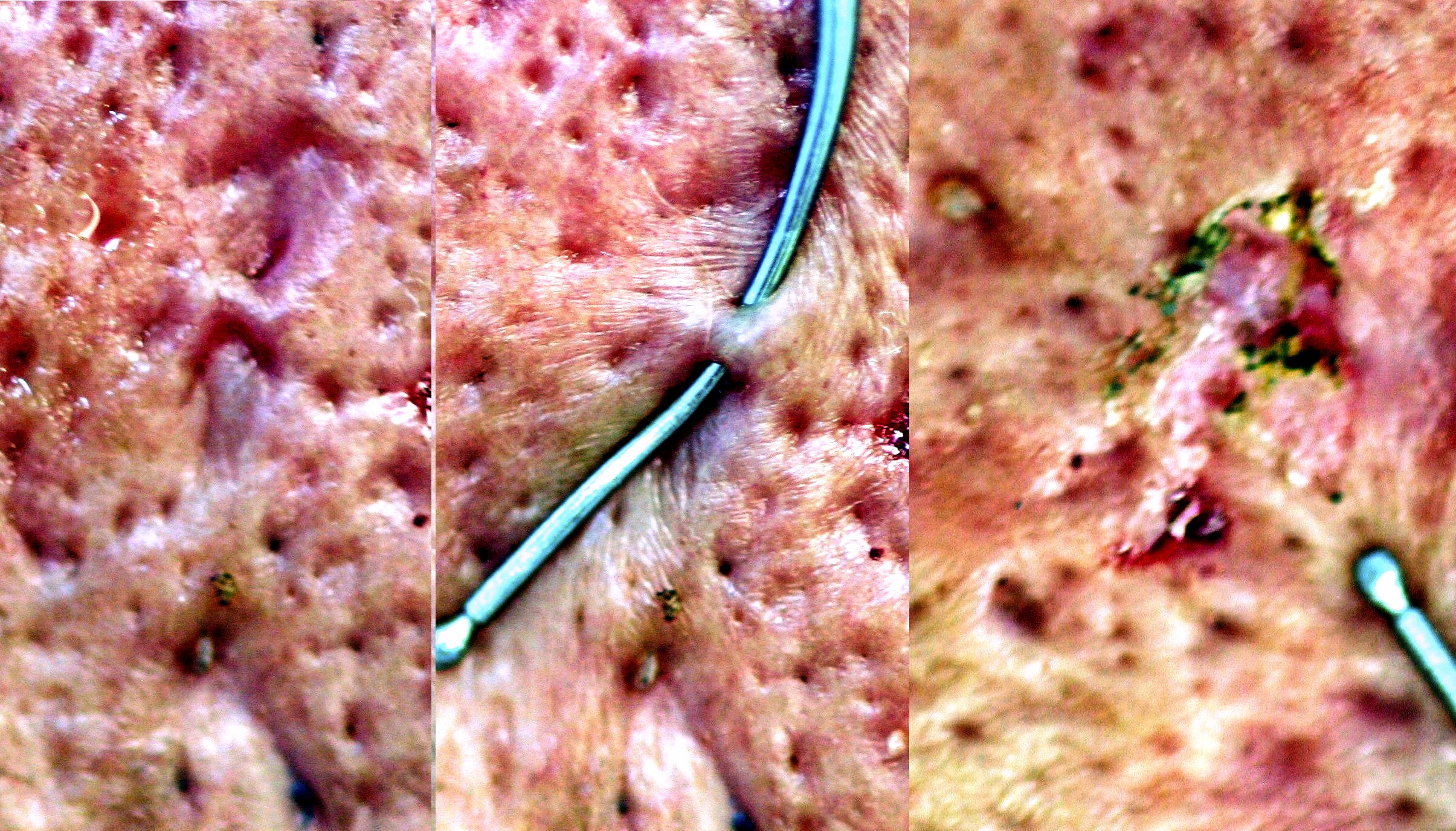 destechamiento puente comedónico