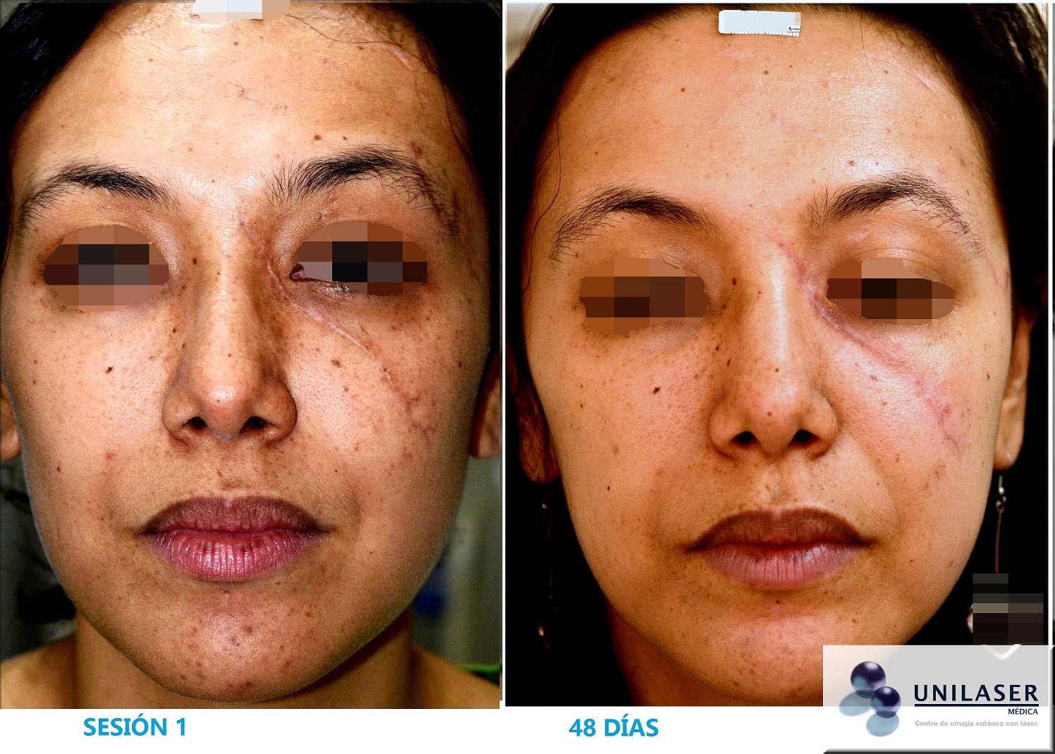 Resultado primera sesión láser