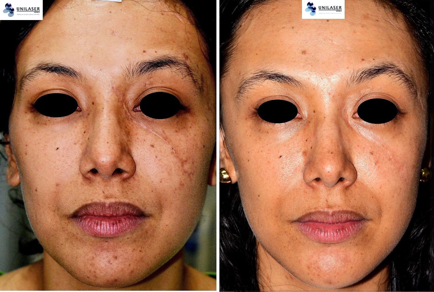 Resultado tratamiento láser cicatrices