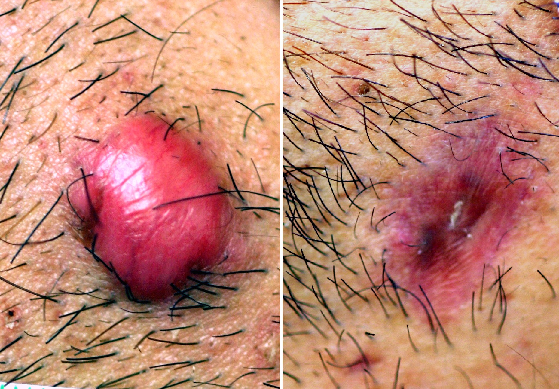 Infiltraciones para queloides
