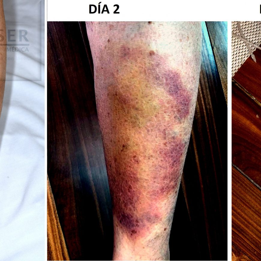 resultado luz roja para hematomas